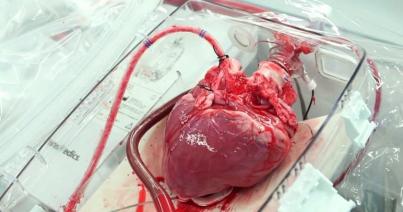 Az első szívátültetést 50 éve végezték el