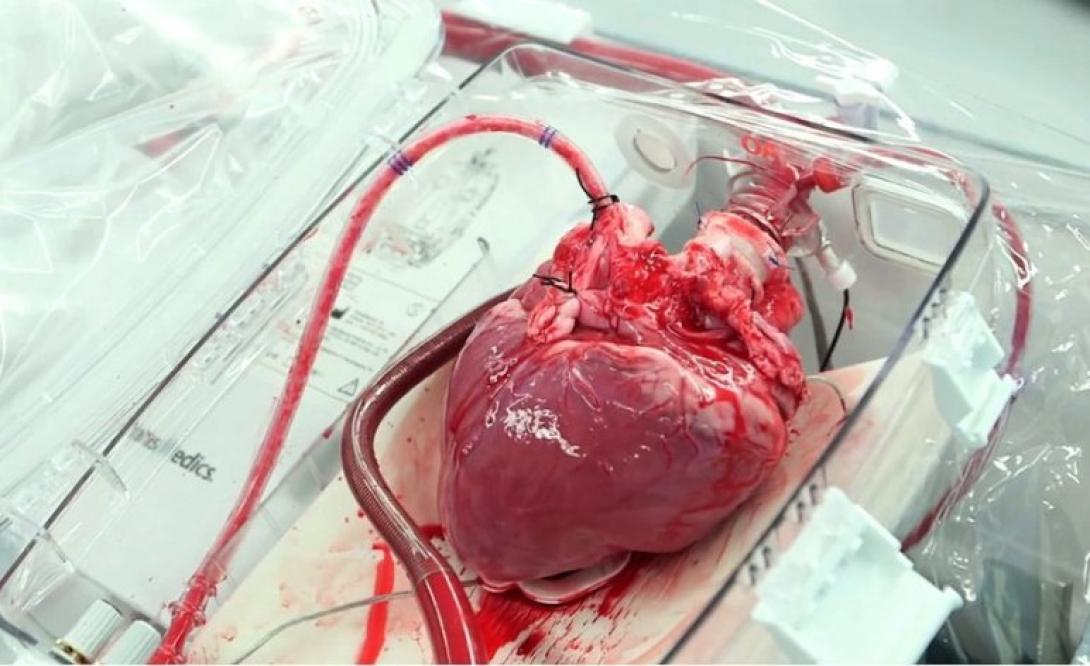 Az első szívátültetést 50 éve végezték el